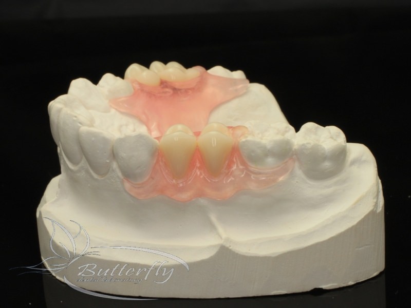 BDLab Dental Laboratory Dental Implants, Prosthesis Flexi Denture